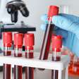 Exame de sangue para Alzheimer pode ajudar a detectar o declínio cognitivo precoce