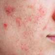 Espinhas depois de começar um novo skincare? Entenda o que pode estar acontecendo