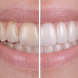 Dentes mais brancos sem agredir o esmalte: o creme dental alemão que reinventou o clareamento