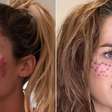 Tatuar sardas vira trend, mas causa infecção e riscos graves