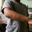 Molusco contagioso na pele: como pega e quando é preciso se preocupar