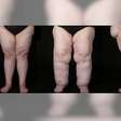 Afinal, o que é lipedema? Consenso internacional define diagnóstico e tratamentos