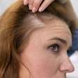 Queda de cabelo na menopausa: conheça a solução