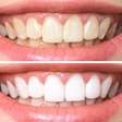 Clareamento dental caseiro: o que realmente funciona, segundo dentistas