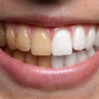 Energéticos: como o consumo pode afetar a saúde dos dentes?