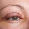 Blefaroplastia: 6 mitos e verdade sobre a cirurgia