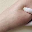 Lipedema: sinais, diferenças da obesidade e importância de diagnóstico correto