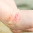 Dermatite atópica: como identificar os sinais em bebês