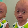 O que é a 'síndrome de Benjamin Button', que vitimou gêmea aos 5 anos em Roraima