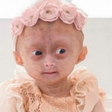 Quem era a gêmea brasileira com 'Síndrome de Benjamin Button' que morreu em Roraima