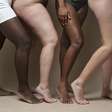 Gordura Localizada ou Lipedema? Entenda as Diferenças Essenciais