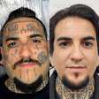 Remoção de tatuagem cresce e muda perfil de quem procura