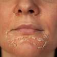 Peeling de fenol: que cuidados devemos ter ao fazer o procedimento estético?