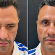 Cleitinho passa por nova harmonização facial um dia após ser eleito governador de Minas Gerais