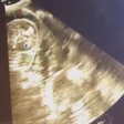 Filhote de tubarão é flagrado abrindo a boca ainda dentro do ventre da mãe em ultrassom