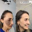 Nevo de Ota pode ser tratado com laser, explica biomédico