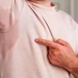 Hiperidrose: quando a cirurgia é indicada para suor excessivo?