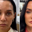 Harmonização facial: antes e depois de Mônica Carvalho chama atenção