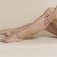 Varizes, lipedema e celulite: saiba como diferenciá-los e cuidar das pernas