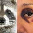 Atenção aos olhos de guaxinim: eles surgiram do nada em mulher de 60 anos e revelaram uma doença rara que pode comprometer o coração e os rins