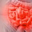 Síndrome do intestino irritável: sintomas, causas e como tratar