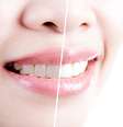 Para que o sorriso fique perfeito, hoje os dentistas têm apostado principalmente em cinco tratamentos  Foto: Shutterstock