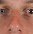 Max Scherzer, jogador norte-americano de basebol, tem uma grande diferença nas cores dos olhos  Foto: Getty Images 