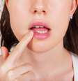 O herpes é uma infecção que causa pequenas bolhas vermelhas e lesões que causam ardência e coceira. O vírus que transmite a doença é o Herpes simplex e estima-se que 90% das pessoas já tiveram contato com o vilão que se manifesta nos lábios  Foto: Shutterstock