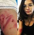 Estudante postou foto com marcas da agressão sofrida durante o protesto  Foto: Reprodução