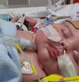 Oscar Tasker nasceu com suas principais artérias ao contrário e sofreu um ataque cardíaco em meio à cirurgia que deveria curá-lo, mas se recuperou com um coração artificial  Foto: Daily Mail / Reprodução