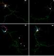 Imagem mostra no topo à esquerda um neurônio normal. À direita deste, está um neurônio de um camundongo com mutação no gene que produz a proteína NHE6. Na parte inferior, à esquerda, aparece novamente um neurônio normal e, à direita, um com defeito - mas ambos tendo recebido tratamento com BDNF  Foto: Morrow lab/Brown University / Divulgação
