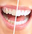 As opções para deixar os dentes brancos crescem a cada dia. Mas existem tratamentos recomendados e seguros que, além de clarear o sorriso, não agridem a saúde da boca  Foto: Shutterstock