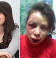 <p>Rosto de Tetyana Chernovil ficou desfigurado após agressão</p>  Foto: Twitter / Reprodução