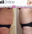 A injeção pode ser aplicada nas bochechas, queixo, costas, barriga, coxas e pescoço  Foto: Reprodução