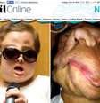 Joanna é a segunda pessoa na Polônia a receber um transplante facial  Foto: Reprodução