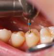 O ozônio abaixa a quantidade de bactérias na região tratada, evita a volta da cárie e ainda dificulta que as bactérias consigam chegar até o nervo do dente  Foto: Shutterstock