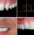 O dentista Cristian Dunker usou o planejamento digital para tratar um paciente que não queria passar por um tratamento com aparelhos ortodônticos ou implantes  Foto: Divulgação