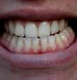 A apneia não causa o bruxismo, mas pode agravá-lo. Por outro lado, a apneia controlada pode fazer com que o bruxismo retorne a níveis toleráveis  Foto: Shutterstock
