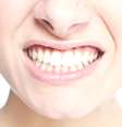 É fundamental procurar um cirurgião-dentista assim que forem detectados os primeiros sangramentos, pois é nessa fase que a inflamação é mais fácil de ser tratada  Foto: Shutterstock