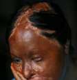 <p>Nalia Raza, 17 anos, foi vítima de violência com ácido em Islamabad, Paquistão em 10 de junho de 2007, tendo de passar por uma cirurgia ocular. Raza foi queimada por ter rejeitado abusos sexuais de seu professor da escola, em uma pequena aldeia no sul do Punjab</p>  Foto: Getty Images 