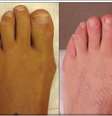 Paciente cinco meses depois da cirurgia para diminuir dedos do pés  Foto: Site do Cosmetic Foot Surgery Centre/Reprodução