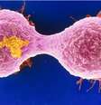 Mutação genética que leva à leucemia também pode causar câncer de mama agressivo  Foto: BBC News Brasil
