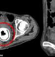 O objeto de 11 cm teria permanecido dentro da vagina da mulher por uma década  Foto: Daily Mail / Reprodução