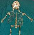 <p>O esqueleto do feto de Kantabai Thakre foi removido 36 anos após a sua gravidez</p>  Foto: Daily Mail / Reprodução