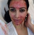 <p>Kim Kardashian já apostou na técnica de tratamento facial com próprio sangue</p>  Foto: Twitter / Reprodução