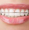 Bruxismo, respiração pela boca e roer a unha podem entortar o dente mesmo com o uso da contenção  Foto: Olga Miltsova / Shutterstock