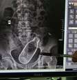 A imagem do raio-X foi divulgada pelos próprios médicos  Foto: The Mirror / Reprodução