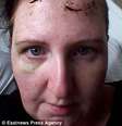 Após alguns meses do incidente, ela concordou em mostrar seu rosto em campanha de sensibilização de abusos dirigida pelo Conselho do Condado de Essex  Foto: Daily Mail / Reprodução