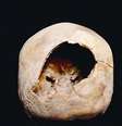 Especialistas garantem que o buraco é relacionado a uma forma primitiva de craniotomia   Foto: Daily Mail  / Reprodução