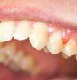 Sangramento na gengiva nem sempre indica periodontite, mas é um indício da necessidade de ouvir a opinião de um especialista  Foto: botazsolti / Shutterstock